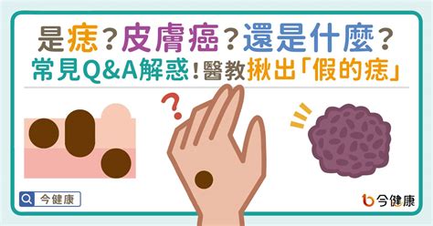 長痣原因|是痣？皮膚癌？還是什麼？常見Q&A解惑！醫教揪出「。